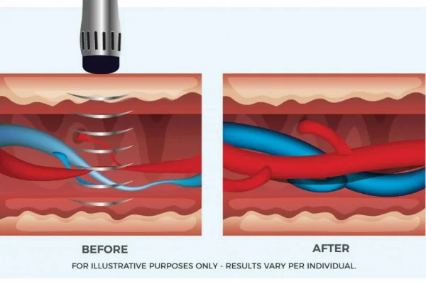 Shockwave Therapy for Erectile Dysfunction